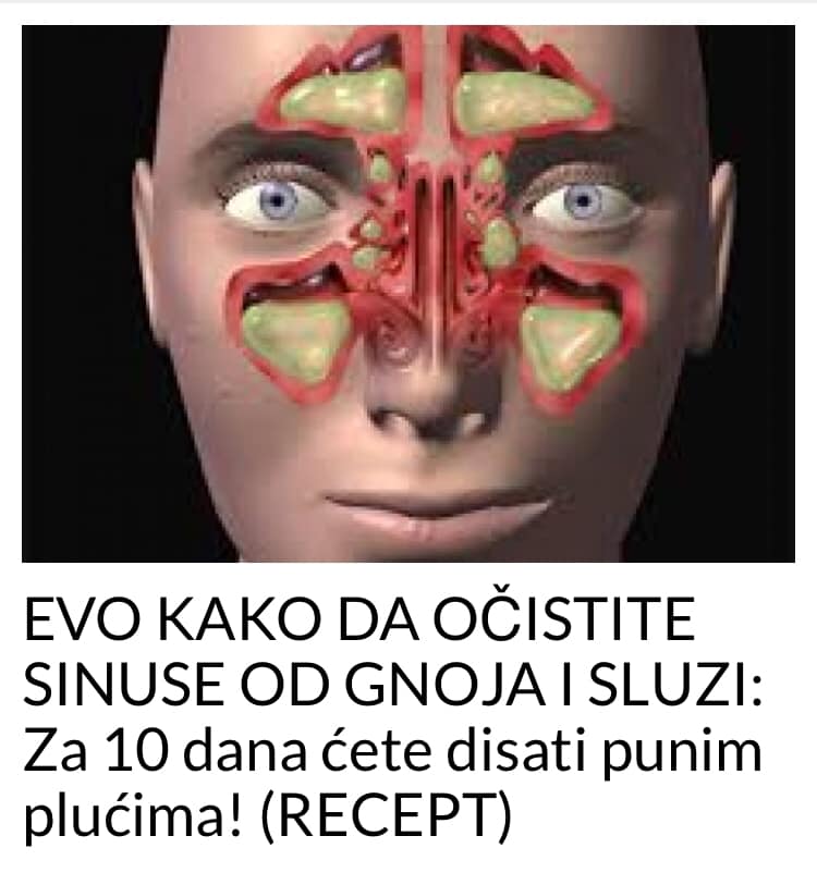 Sinusitis može da izazove česte i uporne glavobolje, ali i infekcije koje se brzo šire i ostavljaju posljedice na zdravlje