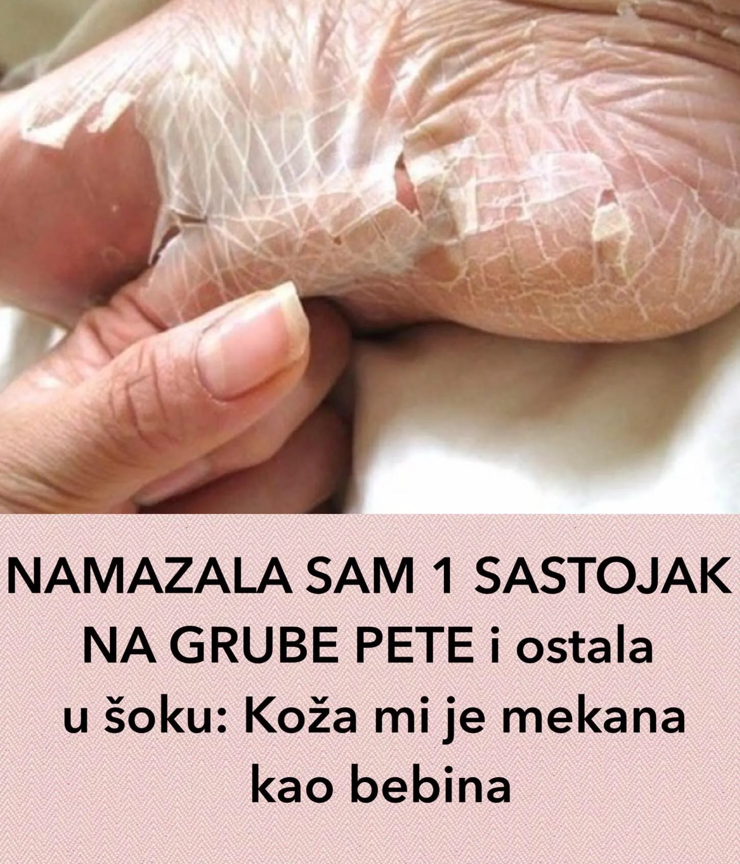 Ispucale pete i pocrnjeli tabani