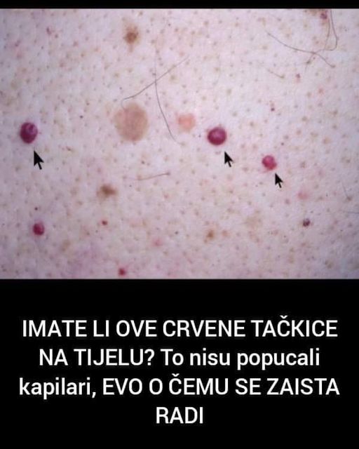 Mnogi na tijelu imaju ove crvene izbočine, ali da li ste se