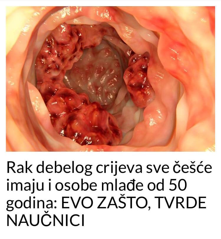 rak debelog creva u trećem stadijumu sa 24 godine.