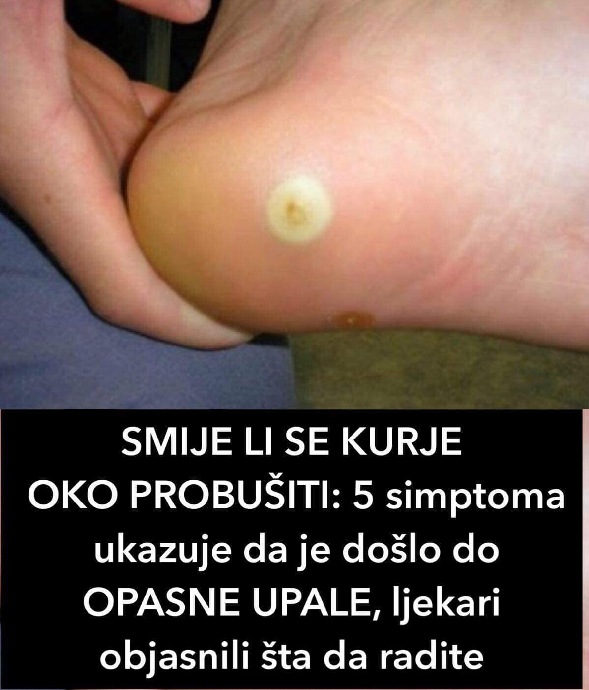 Kurje oko (clavus) je zadebljanje kože koje nastaje najčešće na koži stopala