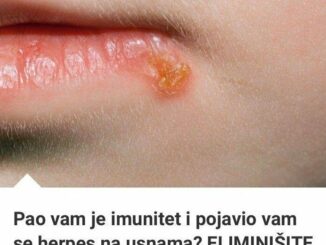 Herpes na usnama je veoma neugodna pojava.