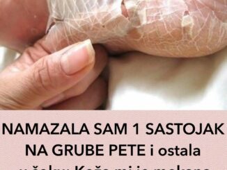 Ispucale pete i pocrnjeli tabani česta su pojava