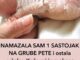 Ispucale pete i pocrnjeli tabani